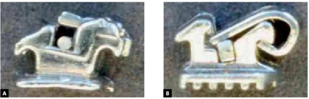 Figure 2 - A) Passive SLB: The buccal clip does not touch the arch wire, B) Active SLB: The buccal clip may  press the wire against the internal surfaces of the slot depending on the wire cross section and diameter