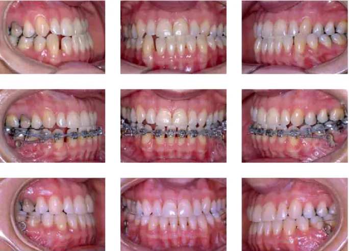 FIGURE 1 - The titanium miniplates may be used in the jaw to serve as anchors for retraction of all the lower teeth