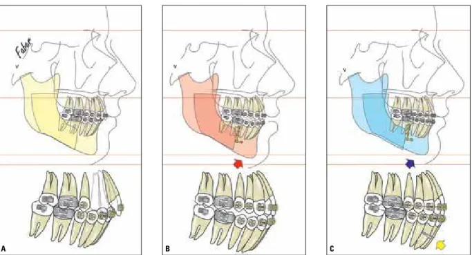 FIGURE 2 - Illustrations representing treatment alternatives for a Pattern II patient with normal face length, through mandibular advancement