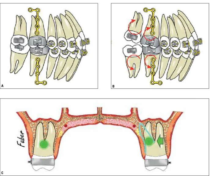 FIGURE 3 - Illustration representing the distalization process of the lower and upper teeth, during the non-extraction double protrusion correction