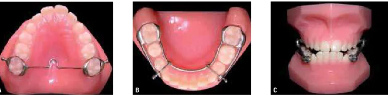 FIGURE 1 -  A ) Maxillary anchorage system with bands and palatal bar.  B ) Mandibular anchorage system with bands and cantilever