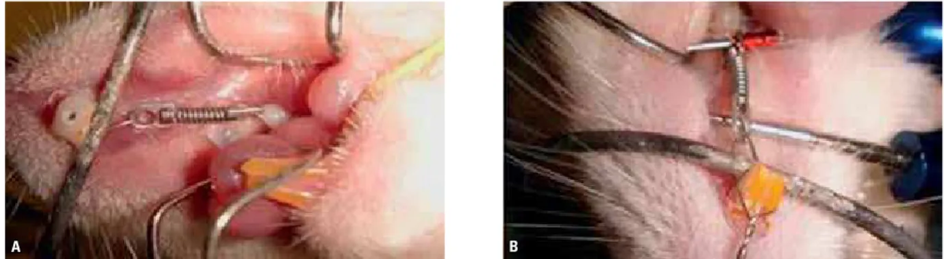 FIGURE 1 - A) Spring system to apply the load on the molar; (B) transferring the load with caliper opening.