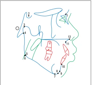 FIGURE 3 - Angles used in this study: 1= S.N.Ar; 2= S.Ar.Go; 3= Ar.Go.Me; 