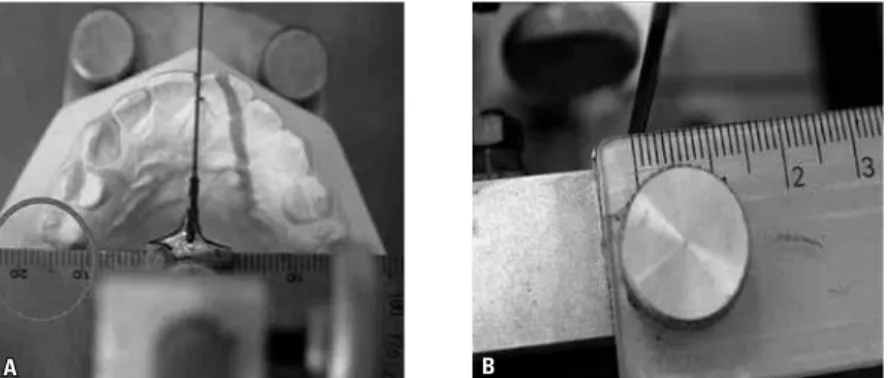 FIGURE 11 - Device positioned at the level of the mesial marginal crest of the right-side maxillary first  molar (A); ruler recording a more mesial positioning of the right-side maxillary first molar by 1.5 mm,  in relation to its left-side counterpart (B)