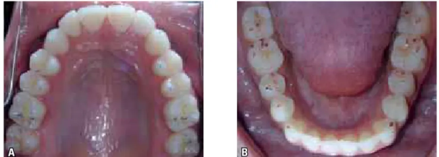 FIGURE 1 - Intraoral photograph of MI contacts in the upper arch (A) and in the lower arch (B)