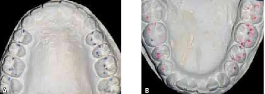 FIGURE 3 - Occlusal contacts in articulated study casts: A) upper and B) lower.