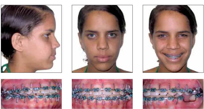 FIGURE 11 - Facial and intraoral postoperative photographs. Surgery performed by Dr Henrique Martins.