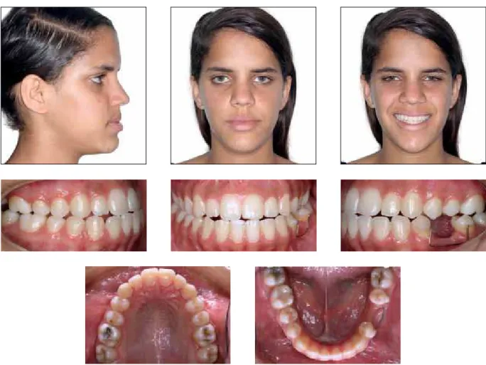FIGURE 12 - Facial and intraoral photographs at the beginning of the second orthosurgical treatment.