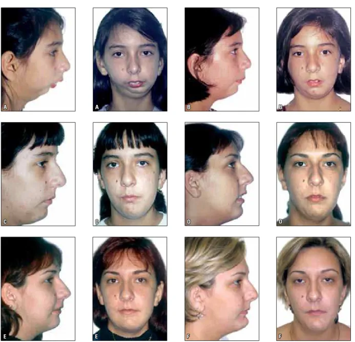 FIGURE 1 - Patient’s facial photographs:  A ) Initial facial photographs,  B ) At 11 years of age, after the first surgical procedure,  C ) At the beginning of orth- orth-odontic treatment,  D ) Photographs prior to orthognathic surgery,  E ) Photographs f