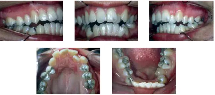 FIGURE 2 - Initial intraoral photographs. 