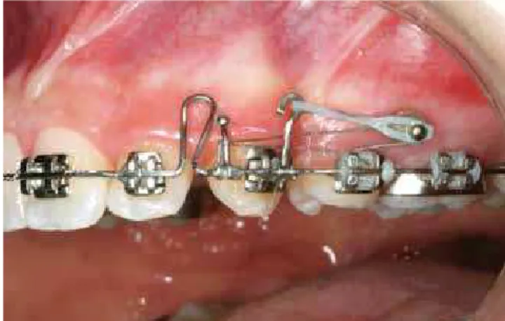 Figure 1 - Photograph showing mass retraction supported by mini-implants.
