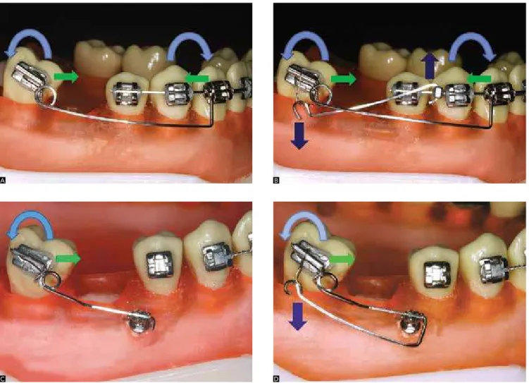 Figure 2 - Molar uprighting through mesial movement of the root, without vertical control