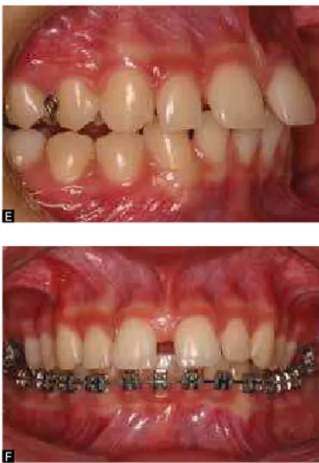 Figure 4 - Facial thirds proportion measured by  means of interposing wax in the occlusion, and  extrusion of posterior teeth obtained by means of  a bite plate.