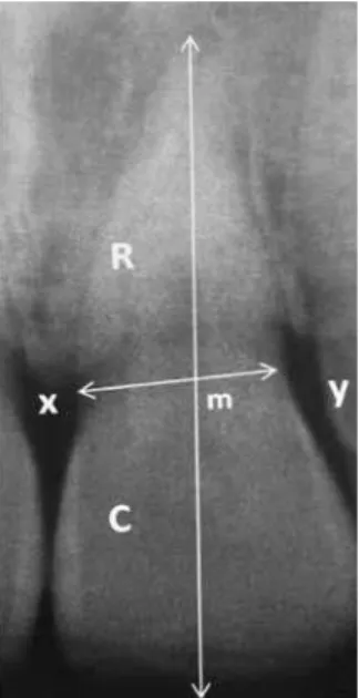 Figure 1 - Measurement of root/crown (R/C) ratio. Points of intersection between the root length, x and y are joined by  a straight line
