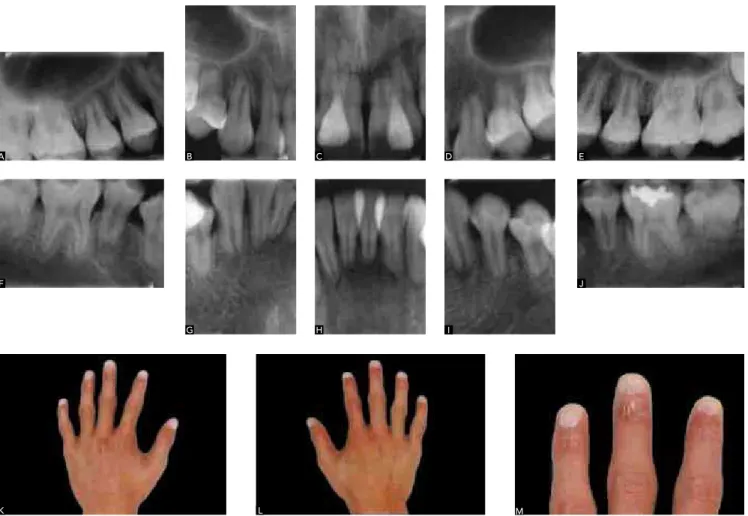Figure 4 - Generalized short root anomaly in patient with congenital dyskeratosis syndrome (a predominantly recessive X-linked syndrome, characterized by the  triad of skin hyperpigmentation, membrane leukoplakia and nail dystrophy)