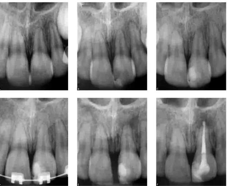 Figure 5 - Radiographic sequence of maxillary central incisors with short root anomaly (SRA)
