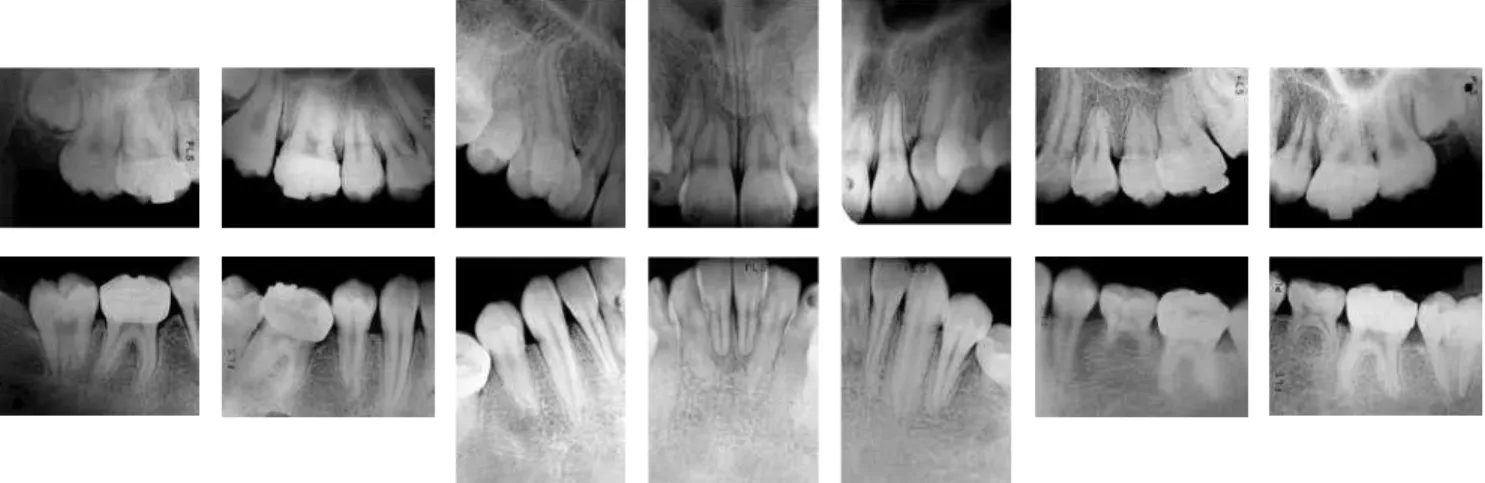 Figure 12 - Initial periapical radiographs.