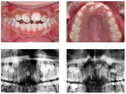 Figure 1 - Mesiodens erupted in the oral cavity.