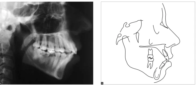 Figure 5 - Initial lateral cephalometric radiograph (A) and cephalometric tracing (B).