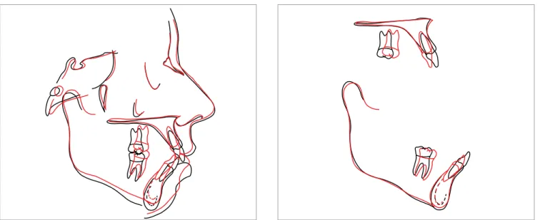 Figure 11 - Total superimposition of initial (black) and inal (red) cephalomet- cephalomet-ric tracings, registered on SN line.