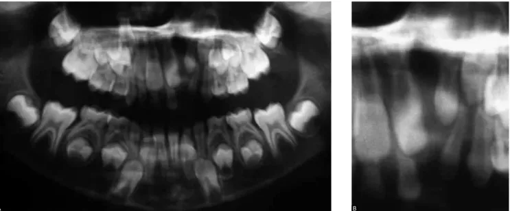 Figure 4 - A) The panoramic radiograph reveals the upper left alveolar bone defect with tooth agenesis # 22