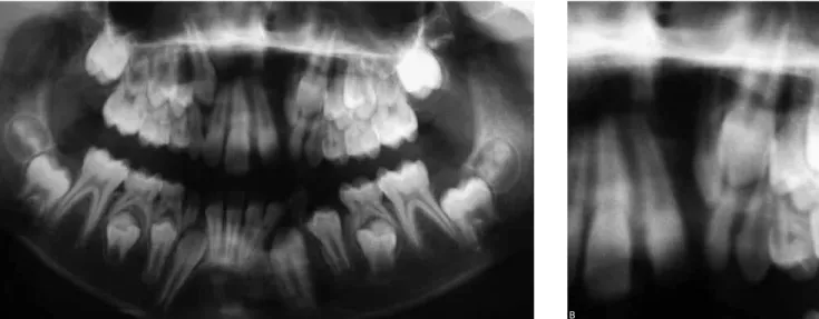 Figure 6 - A) Radiographic image compatible to the alveolar bone defect in complete alveolar cleft