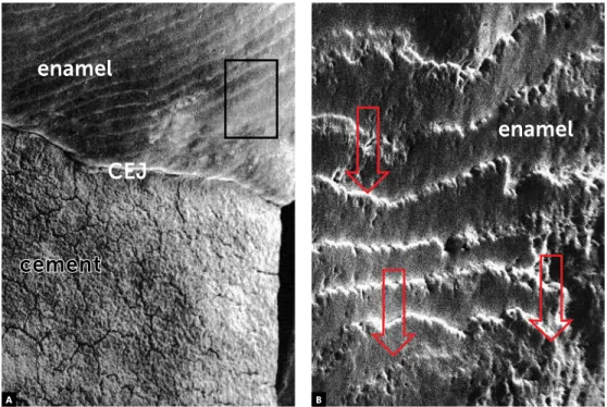 Figure 1 -  Morphological aspects of human enamel surface in scanning electron microscopy: with periky- periky-mata, or wavy, and very porous