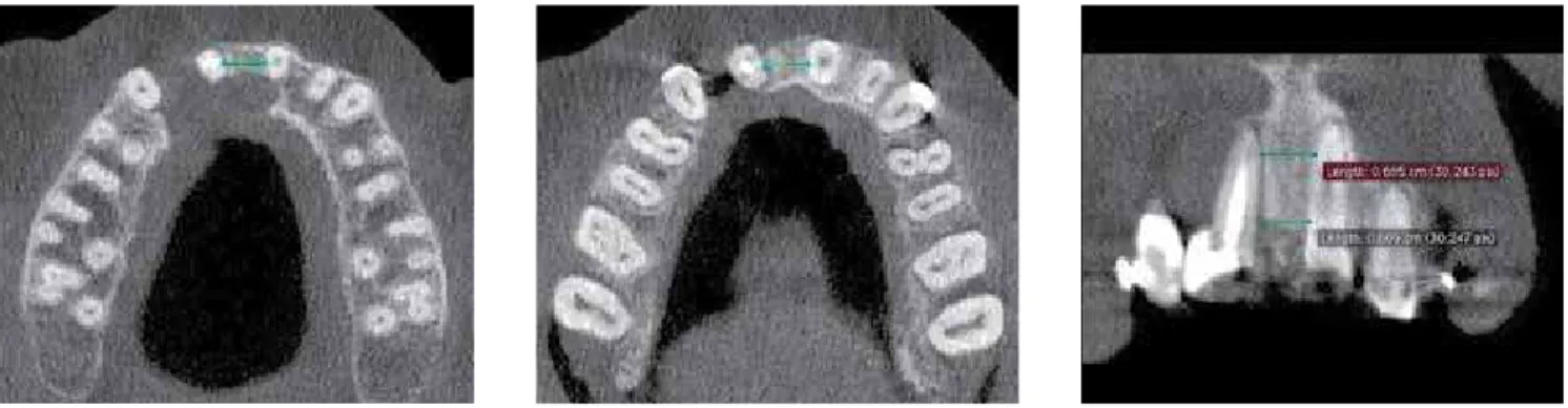 Figure 19 - Tomographic slices demonstrating appropriate space (both vertical and horizontal) for implant placement, taken after treatment.