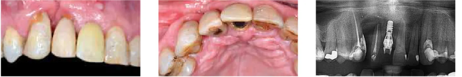 Figure 22 - Photographs taken after the orthodontic appliance had been removed, when the patient was referred to periodontal reevaluation and feasibility of  bone graft in the bone loss area