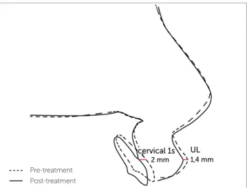 Figure 2 - The impact of upper lip movement caused by retraction of the  upper incisors is strongly correlated with the cervical region of the upper  incisors and corresponds to a mean retrusion of 1.4 mm for every 2 mm of  retraction at this point (nearly