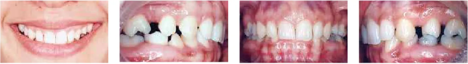 Figure 7 - Smile at the end of treatment demonstrating a preserved contour, exposure of upper anterior teeth and intraoral aspects after orthodontic  correction.