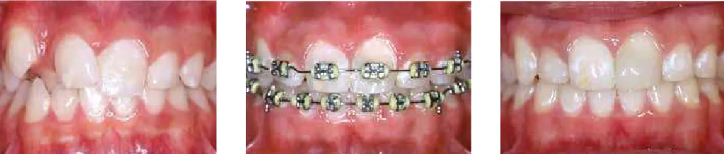 Figure 9 - Trans and post-treatment initial aspect of a patient with enamel hypoplastic spots and white spots worsened after orthodontic treatment.