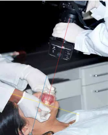 Figure 10 - Virtual height. Behavior of light focusing on anterior teeth (white arrows)