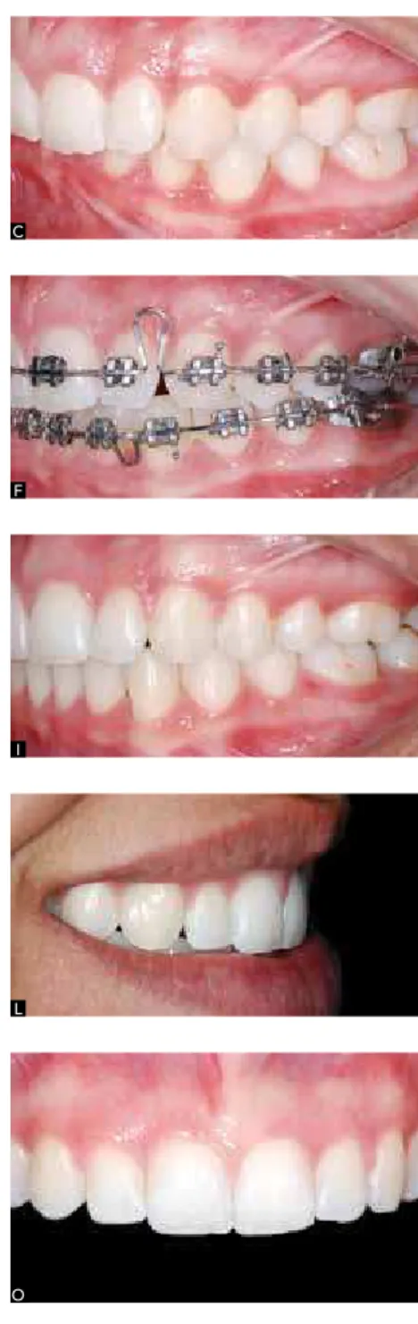 Figure 12 - Angle Class I malocclusion with  cephalometric characteristics of Class II division 2,  hypertonic musculature
