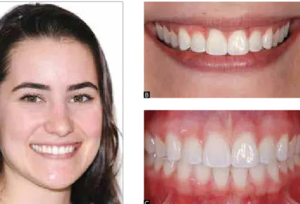 Figure 1 - Esthetical approaches according  to Sarver and Ackerman 48 :  A) Macroesthetics,  seeks the harmony of facial structures; B)  Mini-esthetics, evaluated by the oral structures that  comprise the smile; C) Microesthetics, related to  the teeth and