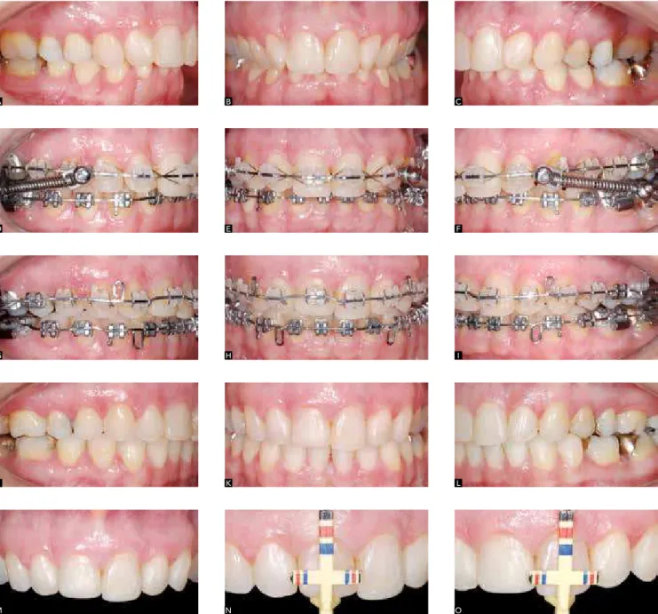Figure 5 - Class II division 1 patient, right subdivision with excessive overbite. A, B, C) Initial case, upper arch with atresia and asymmetric extrusion of anterior teeth