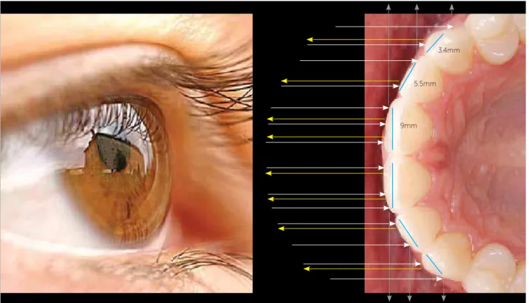 Figure 8 - Virtual width. Behavior of light focusing on anterior teeth (white arrows)