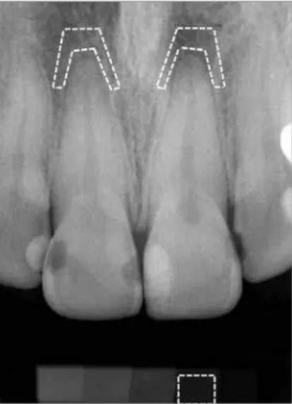 Figure 2 - Scanned periapical radiograph; region of interest selected in apical  region of upper central incisors and on second step of aluminum step-edge  (assessed using Adobe Photoshop CS2 software histogram tool).