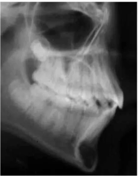 Figure 6 - Post-leveling lateral teleradiograph of  the malocclusion group.