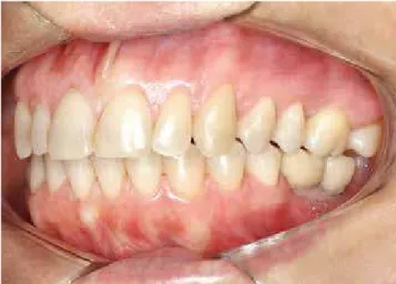 Figure 16 - Study models demonstrating the performed treatment: Initial (A); after intrusion of teeth #26 and #27 (B); crowns placed over implants in the  mandibular arch (C)