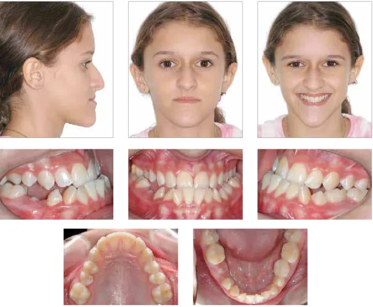 Figure 17 - Facial and intraoral photographs taken at the beginning of the orthodontic treatment in  patient aged 13, with Class III dental and skeletal relationship
