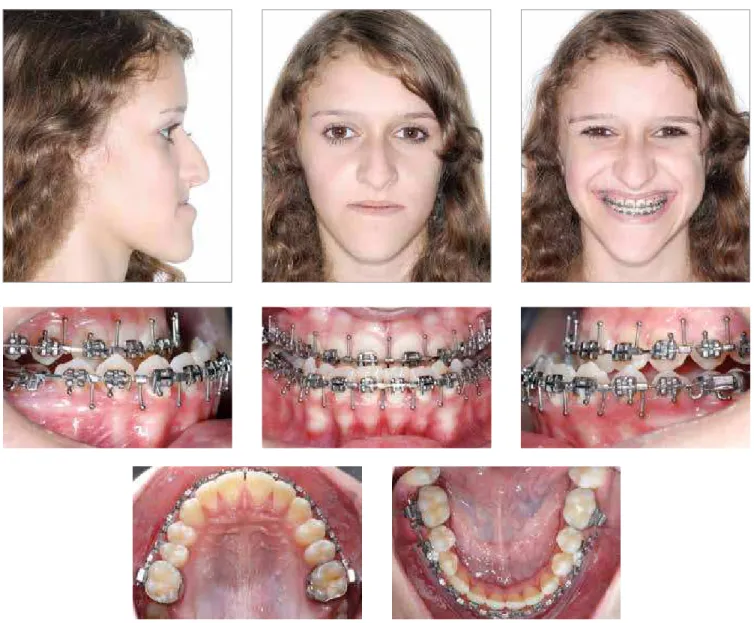 Figure 18 - Facial and intraoral photographs after orthodontic preparation for orthognathic surgery.