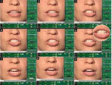 Figure 1 - Video split up into static frames. Frame number 6 (ampliied)  shows the maximum incisor exposure when patients pronounced the sound 