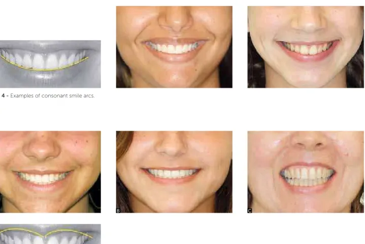 Figure 2 - Upper incisor exposure directly associated with both length and  elevation of the upper lip