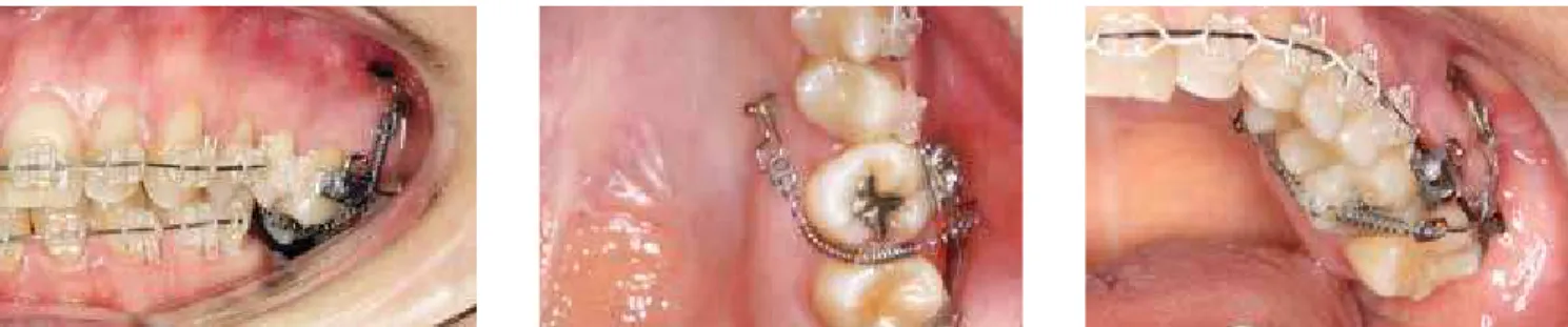 Figure 14 - Placement of miniplate (buccal) and mini-implant (palatal) for anchorage; NiTi spring for intrusion