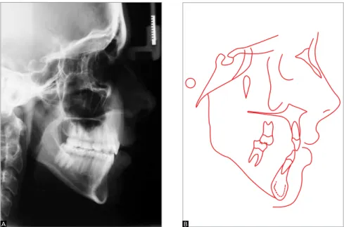 Figure 10 - Final proile cephalometric radiograph (A) and cephalometric tracing (B).