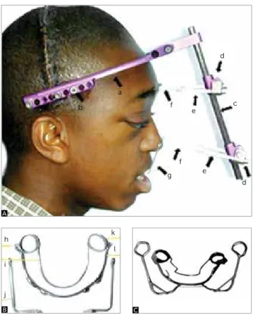 Figure 1 - A) Rigid external distraction device components: (a) cranial exter- exter-nal halo; (b) ixation titanium screws, with active part of 45 mm; (c) carbon  iber anterior vertical rod; (d) distractor screws; (e) horizontal bars; (f) surgical  steel w