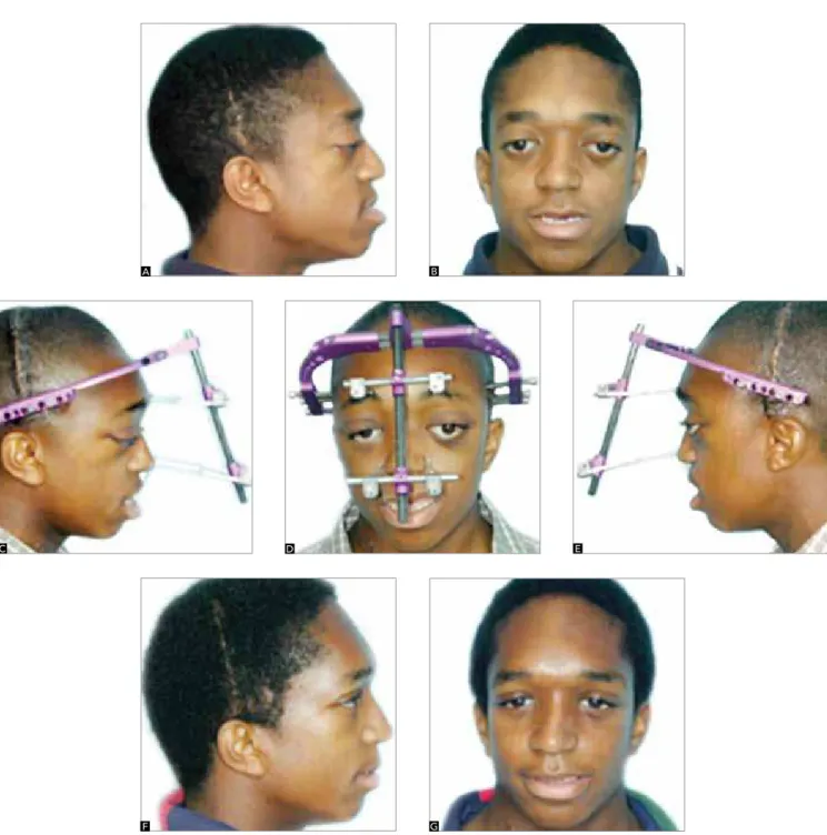 Figure 6 - A, B) Adolescent with Crouzon syndrome, maxillary and midface hypoplasia. C, D, E) Facial photographs after restorative surgery during childhood