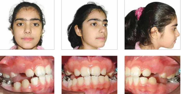 Figure 11 - Beginning of treatment, the FLMGM in place. Facial and intraoral photographs
