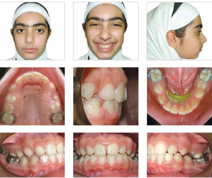 Figure 12 - Facial and intraoral photographs immediately after removal of the maxillary part, promoting a normal incisor relationship, with buccal segments  partially out of occlusion.